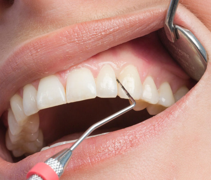 Сохранение подвижных зубов